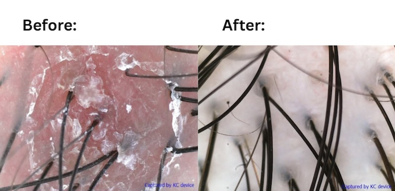 TK TrichoKare Exosome - after