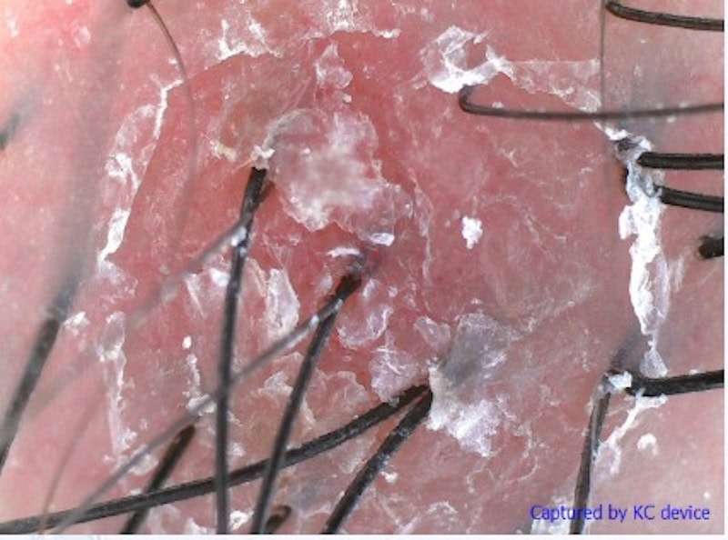 TK TrichoKare Exosome - before